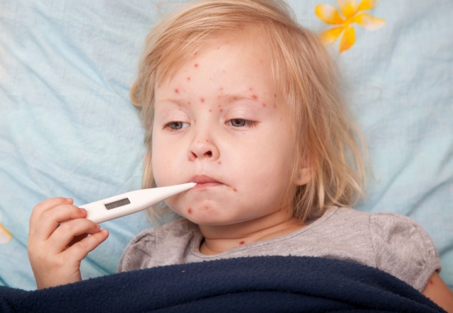 Trẻ mắc bệnh sởi là đối tượng cần được bổ sung Vitamin A.